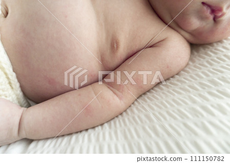 Eczema on newborn baby's body Eczema on newborn baby's body 111150782