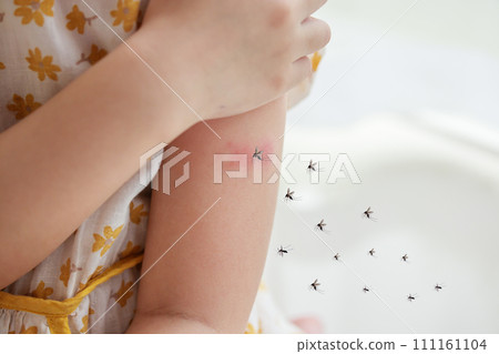 Little girl has skin rash allergy and itchy on her arm from mosquito bite 111161104