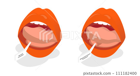 3D Isometric Flat  Conceptual Illustration of Ankyloglossia 111182400