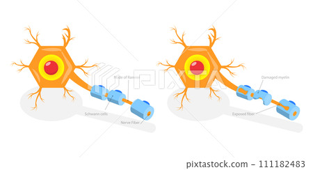 3D Isometric Flat  Conceptual Illustration of Multiple Sclerosis 111182483