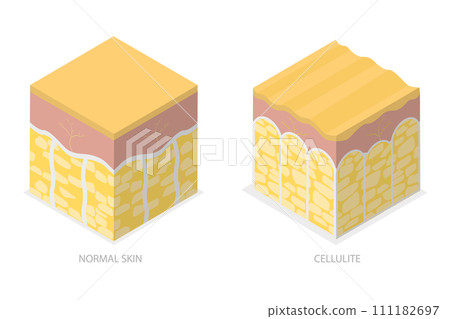 3D Isometric Flat  Conceptual Illustration of Cellulite Skin, Womans Beauty and Skicare 111182697