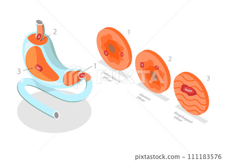 3D Isometric Flat  Conceptual Illustration of Peptic Ulcer Stomach Disease, Gastritis and Inflammation 111183576