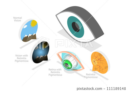 3D Isometric Flat  Conceptual Illustration of Retinal Degenerative Vision 111189148