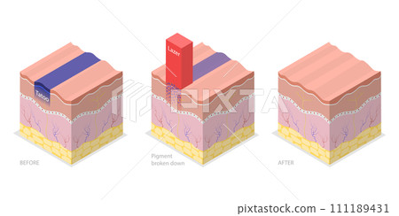 3D Isometric Flat Conceptual Illustration of Laser Tattoo Removing 3D Isometric Flat Conceptual Illustration of Laser Tattoo Removing 111189431
