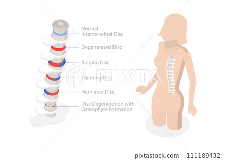 3D Isometric Flat  Conceptual Illustration of Degenerative Disc Disease 111189432