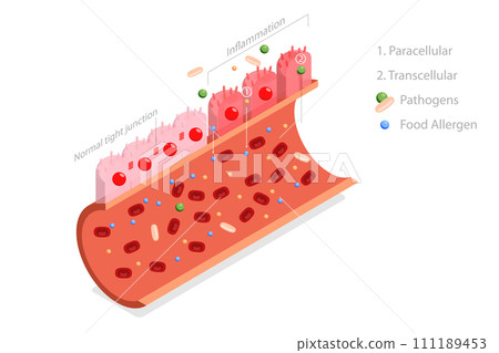 3D Isometric Flat Conceptual Illustration of Leaky Gut Syndrome 3D Isometric Flat Conceptual Illustration of Leaky Gut Syndrome 111189453