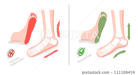 3D Isometric Flat  Conceptual Illustration of Flat Foot 111189459