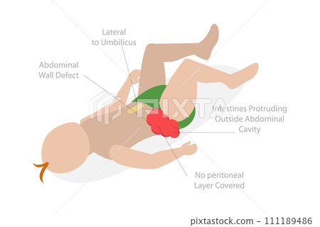 3D Isometric Flat  Conceptual Illustration of Gastroschisis 111189486