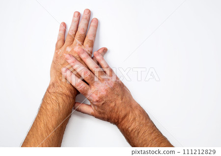 Hands with vitiligo skin pigmentation on white background close-up.  111212829