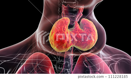 Enlarged thyroid gland, 3D illustration Enlarged thyroid gland, 3D illustration 111228185