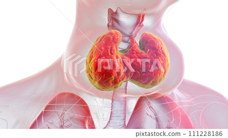 Enlarged thyroid gland, 3D illustration Enlarged thyroid gland, 3D illustration 111228186