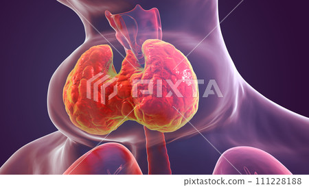 Enlarged thyroid gland, 3D illustration 111228188