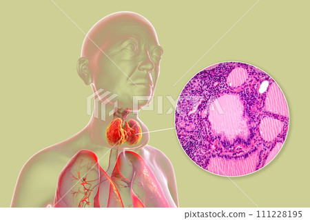 Toxic goiter, 3D illustration and micrograph Toxic goiter, 3D illustration and micrograph 111228195