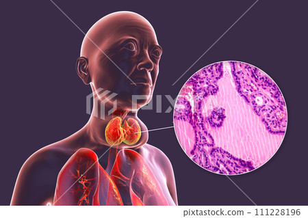 Toxic goiter, 3D illustration and micrograph Toxic goiter, 3D illustration and micrograph 111228196
