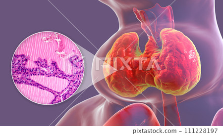 Toxic goiter, 3D illustration and micrograph Toxic goiter, 3D illustration and micrograph 111228197