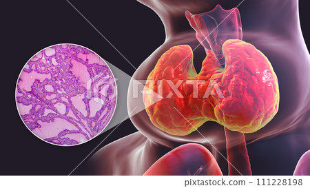 Toxic goiter, 3D illustration and micrograph 111228198