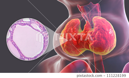Endemic goiter, 3D illustration and light micrograph Endemic goiter, 3D illustration and light micrograph 111228199
