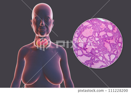 Toxic goiter, 3D illustration and micrograph Toxic goiter, 3D illustration and micrograph 111228200