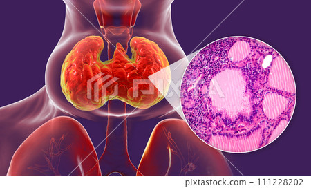 Toxic goiter, 3D illustration and micrograph Toxic goiter, 3D illustration and micrograph 111228202