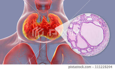 Endemic goiter, 3D illustration and light micrograph Endemic goiter, 3D illustration and light micrograph 111228204