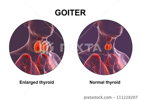 Enlarged thyroid gland, 3D illustration 111228207