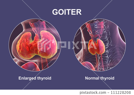 Enlarged thyroid gland, 3D illustration Enlarged thyroid gland, 3D illustration 111228208