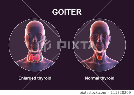 Enlarged thyroid gland, 3D illustration Enlarged thyroid gland, 3D illustration 111228209