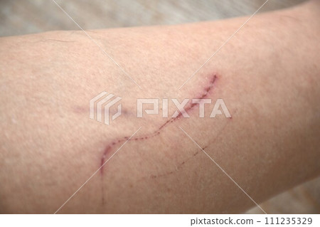 suture scratching scar from accident on man sibling background and texture 111235329