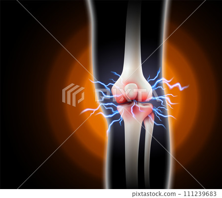 Knee pain and pain in the bones Arthritis of the knee on black background. Realistic 3d vector file. 111239683