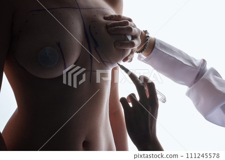 Breast Augmentation. Closeup Beautician Hands In Gloves Drawing Surgical Lines On Beautiful Woman Breast. Sexy Female Body With Black Marks On Breasts Before Plastic Surgery Operation. High Resolution 111245578