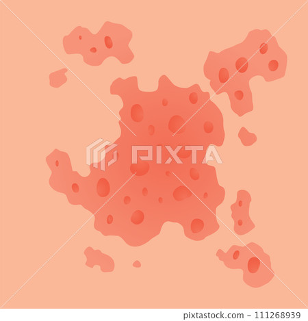 Type of psoriasis vector. Part of patients skin with dermatitis, inflammation, red rash and other skin problems. Cartoon illustration for disease concept Type of psoriasis vector. Part of patients skin with dermatitis, inflammation, red rash and other skin problems. Cartoon illustration for disease concept 111268939