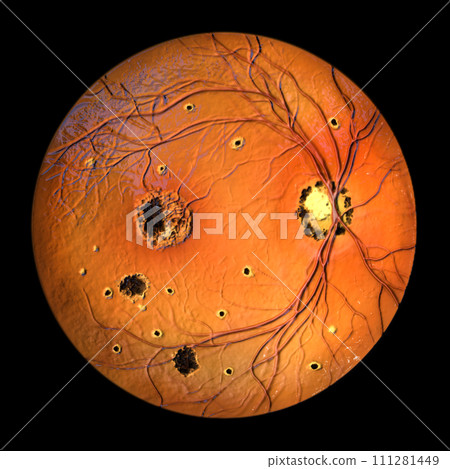 Retina in Ocular Histoplasmosis Syndrome, 3D illustration Retina in Ocular Histoplasmosis Syndrome, 3D illustration 111281449
