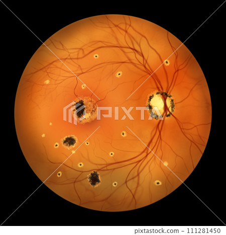 Retina in Ocular Histoplasmosis Syndrome, illustration Retina in Ocular Histoplasmosis Syndrome, illustration 111281450