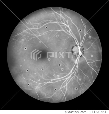 Retina in Ocular Histoplasmosis Syndrome, illustration Retina in Ocular Histoplasmosis Syndrome, illustration 111281451