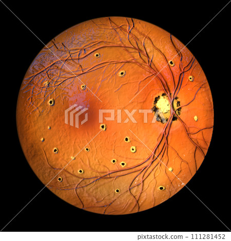 Retina in Ocular Histoplasmosis Syndrome, 3D illustration Retina in Ocular Histoplasmosis Syndrome, 3D illustration 111281452