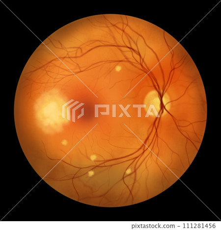 A blastomycosis-affected retina, illustration 111281456