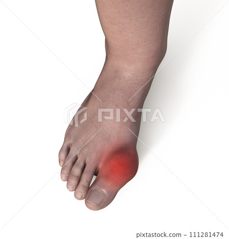 Gout-afflicted foot, 3D illustration 111281474