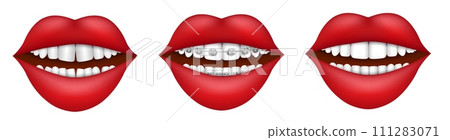 Female mouth with dental braces, crooked and straight teeth 111283071
