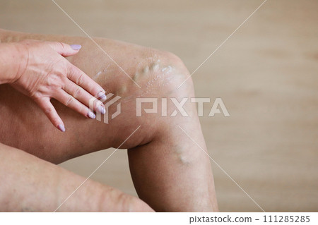 The woman rubs tired legs with a special cream to reduce pain. Phlebology. Painful varicose and spider veins on active female legs, medicine and health. 111285285