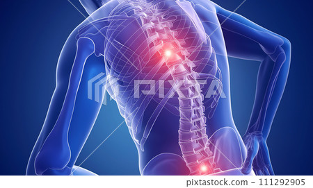 Visual representation of lower back pain: An image that embodies pain and discomfort in the lumbar area <AI-generated material> 111292905