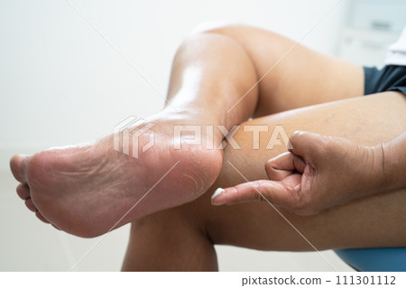Asian woman care feet with cracked and dry heel skin cream at home. 111301112