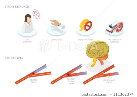 3D Isometric Flat Conceptual Illustration of Brain Blood Supply Problem, Ischemic Stroke Attack 3D Isometric Flat Conceptual Illustration of Brain Blood Supply Problem, Ischemic Stroke Attack 111362374