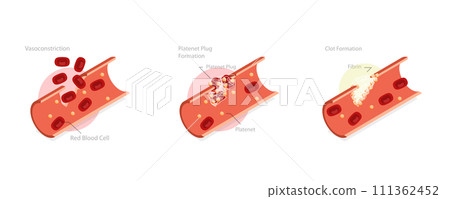 3D Isometric Flat Conceptual Illustration of Hemostasis, Wound Healing Process Stages, Vasoconstriction and Clot Formation 3D Isometric Flat Conceptual Illustration of Hemostasis, Wound Healing Process Stages, Vasoconstriction and Clot Formation 111362452