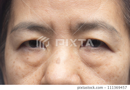Senior asian woman worry about eye bags and dark spot. 111369457