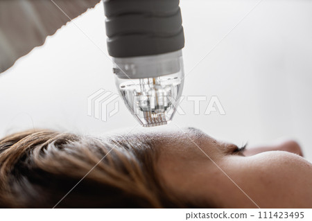 Woman receiving laser treatment for facial rejuvenation 111423495