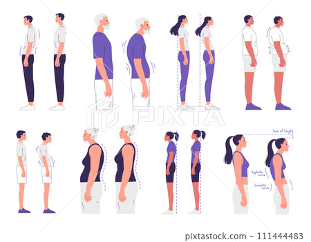People with correct and incorrect posture. Scoliosis, curvature of the spine People with correct and incorrect posture. Scoliosis, curvature of the spine 111444483