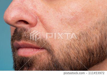 Girl with acne stick round acne patch on her cheek. Using acne patches for treatment of pimple and rosacea close-up. Facial rejuvenation cleansing cosmetology Girl with acne stick round acne patch on her cheek. Using acne patches for treatment of pimple and rosacea close-up. Facial rejuvenation cleansing cosmetology 111453972