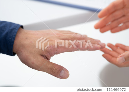 Medical atopic dermatitis at hand 111466972