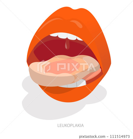 3D Isometric Flat Vector Illustration of Sore Or White Tongue. Item 1 3D Isometric Flat Vector Illustration of Sore Or White Tongue. Item 1 111514973