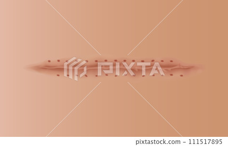 Healing wounds, skin scar, stitched gash and cut. Realistic surgical suture, stitched wounds. Healing stage on human skin background. Vector illustration 111517895
